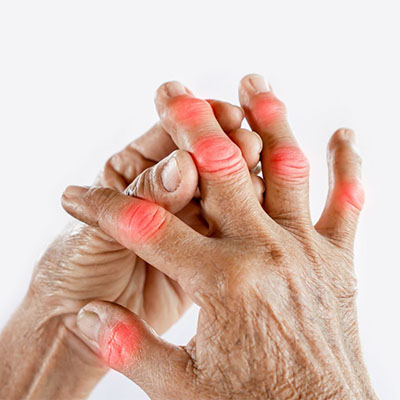 Arthritis Treatment By Dr Bavneet Kaur Dang